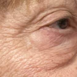 Blepharoplasty Before & After Patient #11148
