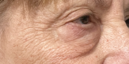 Blepharoplasty Before & After Patient #11148