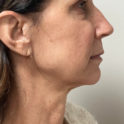 HourLift Before & After Patient #11154