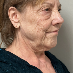 HourLift Before & After Patient #11143