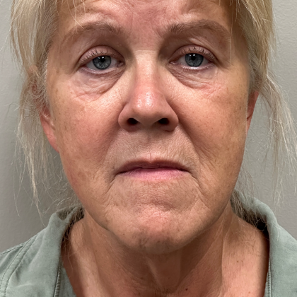 HourLift Before & After Patient #11155