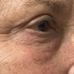 Blepharoplasty Before & After Patient #11148