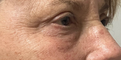 Blepharoplasty Before & After Patient #11148