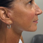 HourLift Before & After Patient #11154