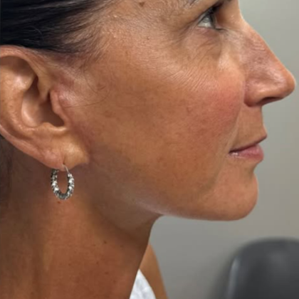 HourLift Before & After Patient #11154