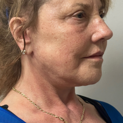 HourLift Before & After Patient #11143