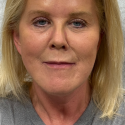 HourLift Before & After Patient #11155