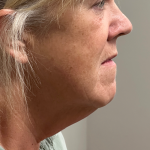 HourLift Before & After Patient #11155