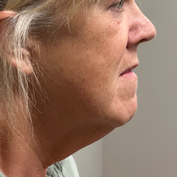 Neck Liposuction Before & After Patient #11160