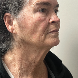HourLift Before & After Patient #11149