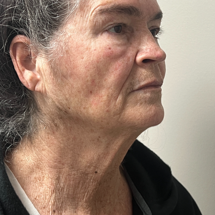 HourLift Before & After Patient #11149