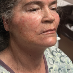 HourLift Before & After Patient #11149