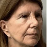 HourLift Before & After Patient #12813