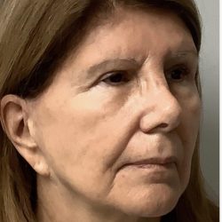 HourLift Before & After Patient #12813