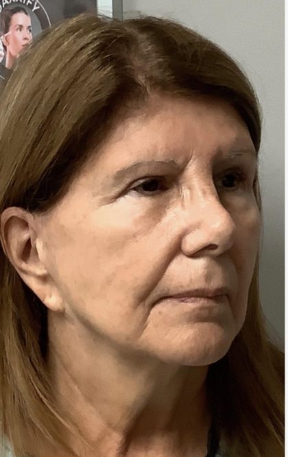 HourLift Before & After Patient #12813