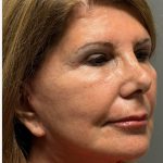 HourLift Before & After Patient #12813
