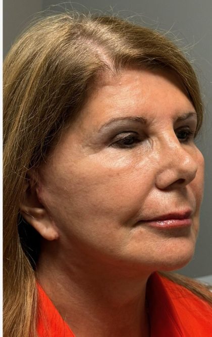 HourLift Before & After Patient #12813