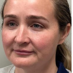 HourLift Before & After Patient #12803