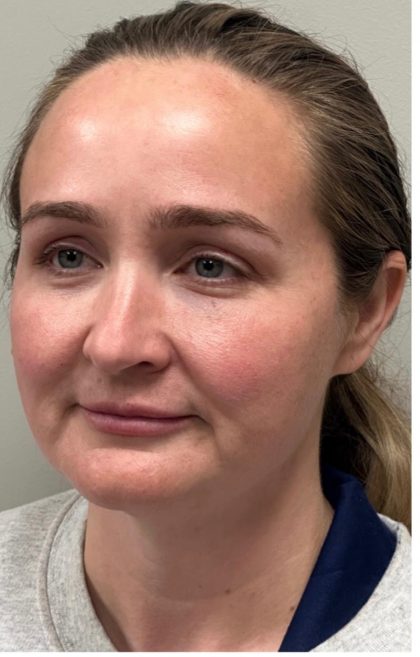 HourLift Before & After Patient #12803