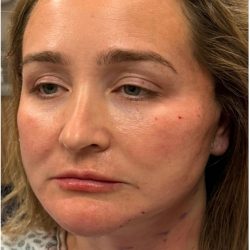 HourLift Before & After Patient #12803