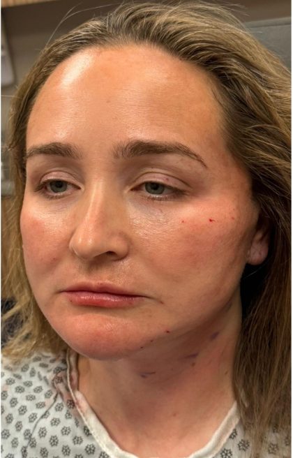 HourLift Before & After Patient #12803