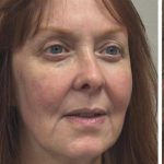 HourLift Before & After Patient #12811