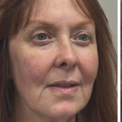 HourLift Before & After Patient #12811
