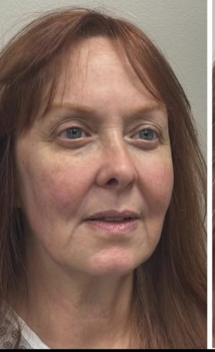 HourLift Before & After Patient #12811