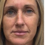 HourLift Before & After Patient #12810