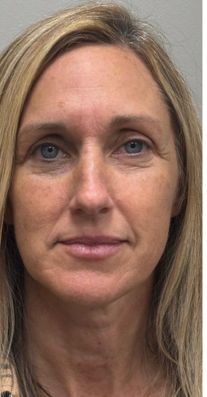 HourLift Before & After Patient #12810