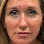 HourLift Before & After Patient #12810