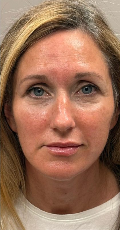 HourLift Before & After Patient #12810