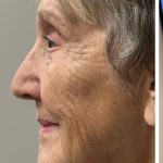 HourLift Before & After Patient #12809