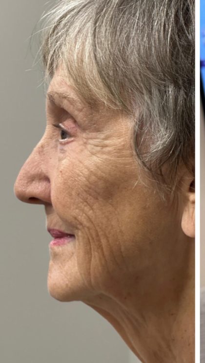 HourLift Before & After Patient #12809