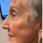 HourLift Before & After Patient #12809
