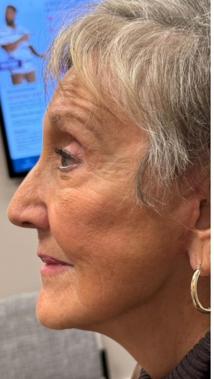 HourLift Before & After Patient #12809