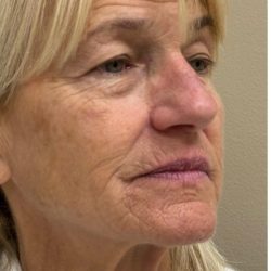 HourLift Before & After Patient #12808