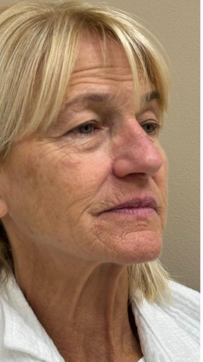 HourLift Before & After Patient #12808