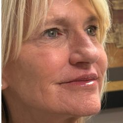 HourLift Before & After Patient #12808