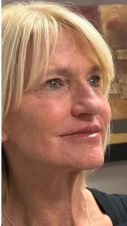 HourLift Before & After Patient #12808