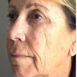 HourLift Before & After Patient #12807