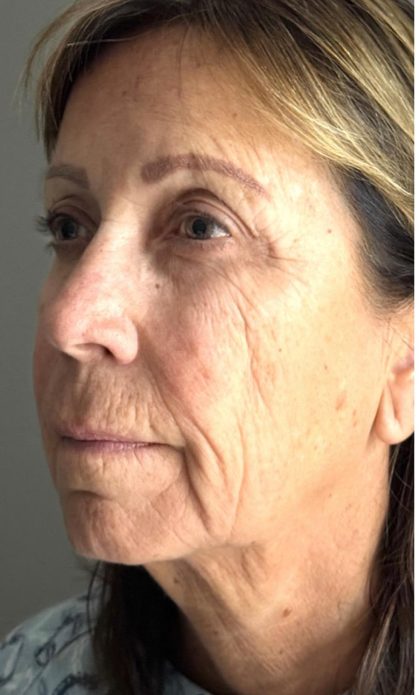HourLift Before & After Patient #12807
