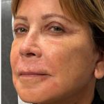 HourLift Before & After Patient #12807