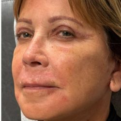 HourLift Before & After Patient #12807