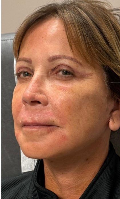 HourLift Before & After Patient #12807