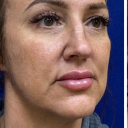 HourLift Before & After Patient #12806
