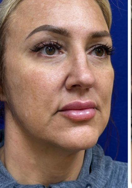 HourLift Before & After Patient #12806