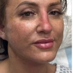 HourLift Before & After Patient #12806