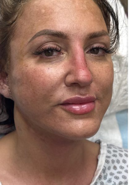 HourLift Before & After Patient #12806