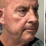HourLift Before & After Patient #12805
